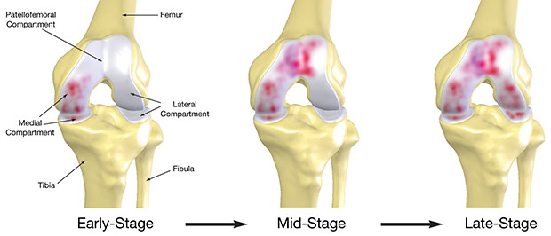 Artrosi del ginocchio: gonartrosi