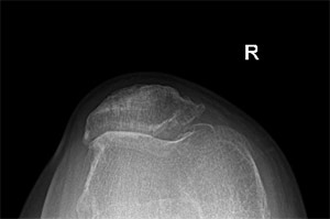 Radiografia che mostra un’artrosi selettiva del comparto femoro rotuleo