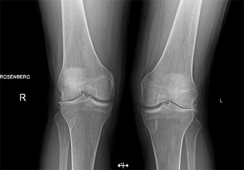 Radiografia che mostra un’artrosi selettiva del comparto laterale che coinvolge entrambe le ginocchia