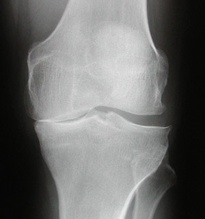 Radiografia che mostra un’artrosi selettiva del comparto mediale del ginocchio