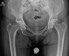Coxartrosi destra - Trattata con protesi di anca destra mini invasiva