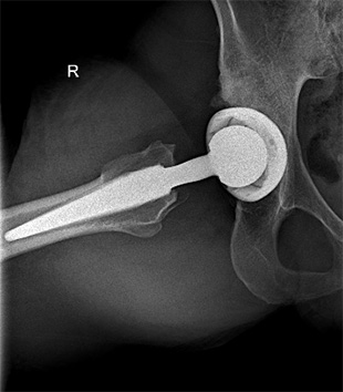 Coxartrosi su displasia di anca a destra - Intervento di protesi mini invasiva anca destra