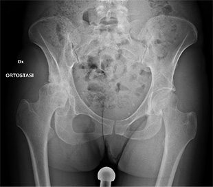 Coxartrosi su displasia di anca a destra - Intervento di protesi mini invasiva anca destra