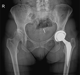 Coxartrosi sinistra: trattata con protesi di anca con tecnica mini invasiva