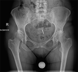 Coxartrosi sinistra: trattata con protesi di anca con tecnica mini invasiva
