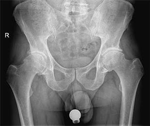 Coxartrosi - Protesi totale dell'anca