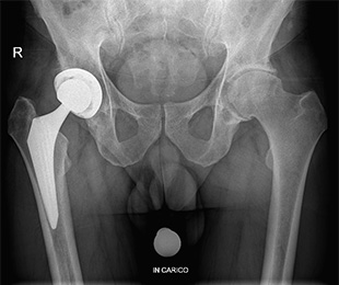 Coxartrosi - Protesi totale dell'anca