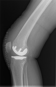 Intervento di protesi monocompartimentale mini invasiva a destra e protesi totale a conservazione del legamento crociato posteriore mini invasiva a sinistra