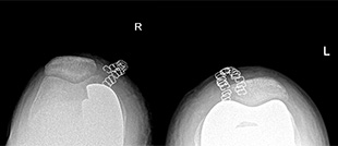 Intervento di protesi monocompartimentale mini invasiva a destra e protesi totale a conservazione del legamento crociato posteriore mini invasiva a sinistra