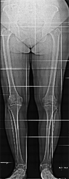 Gonartrosi mediale bilaterale: inserimento protesi monocompartimentale mediale bilaterale di ginocchio con tecnica mini invasiva.