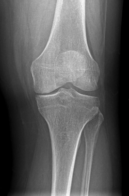 Gonartrosi mediale bilaterale: inserimento protesi monocompartimentale mediale bilaterale di ginocchio con tecnica mini invasiva