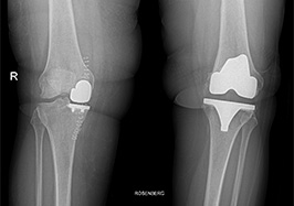 Gonartrosi mediale destra: intervento di protesi monocompartimentale mediale con tecnica mini invasiva