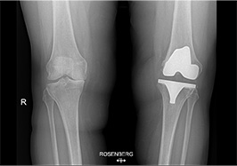 Gonartrosi mediale destra: intervento di protesi monocompartimentale mediale con tecnica mini invasiva