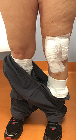 Gonartrosi sinistra: inserimento protesi monocompartimentale mediale + protesi femoro rotulea ginocchio sinistro
