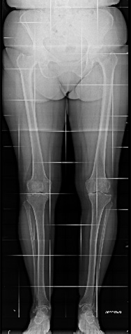 Coxartrosi destra - Trattata con protesi di anca destra mini invasiva