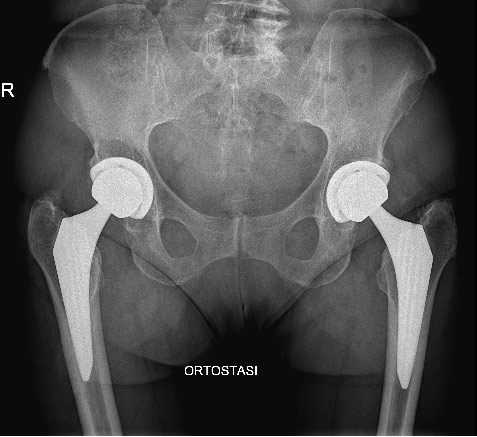 Protesi dell'anca bilaterale