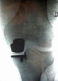 Protesi del ginocchio monocompartimentale - Chirurgia protesica del ginocchio - Milano - Bergamo - Bari