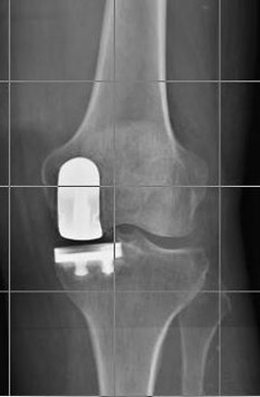 Protesi monocompartimentale di ginocchio
