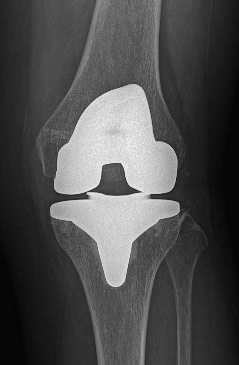 Protesi totale di ginocchio