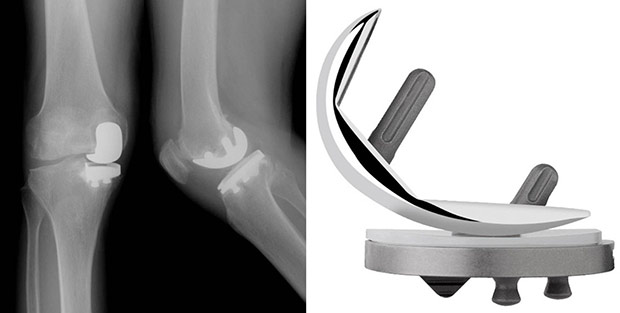 Radiografie in 2 proiezioni di una protesi monocompartimentale mediale di ginocchio e protesi impiantata