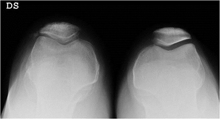 Intervento chirurgico di protesi monocompartimentale di ginocchio femoro-rotulea