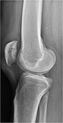 Intervento chirurgico di protesi monocompartimentale di ginocchio femoro-rotulea