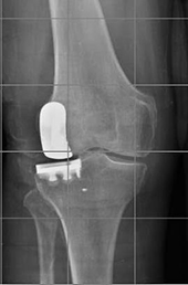 protesi monocompartimentale di ginocchio del comparto laterale
