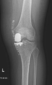 protesi monocompartimentale di ginocchio del comparto mediale