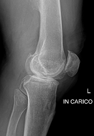 Gonartrosi mediale: inserimento protesi monocompartimentale ginocchio mediale con tecnica mini invasiva