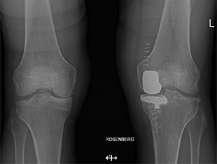 Gonartrosi mediale: inserimento protesi monocompartimentale mediale con tecnica mini invasiva
