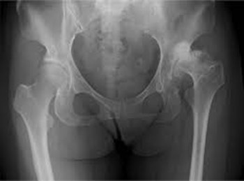 Radiografia che mostra artrosi dell'anca