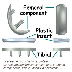 protesi ginocchio monocompartimentale - elementi